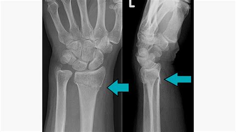 X Ray Of Human Hand With Broken Wrist Fracture Of Radius