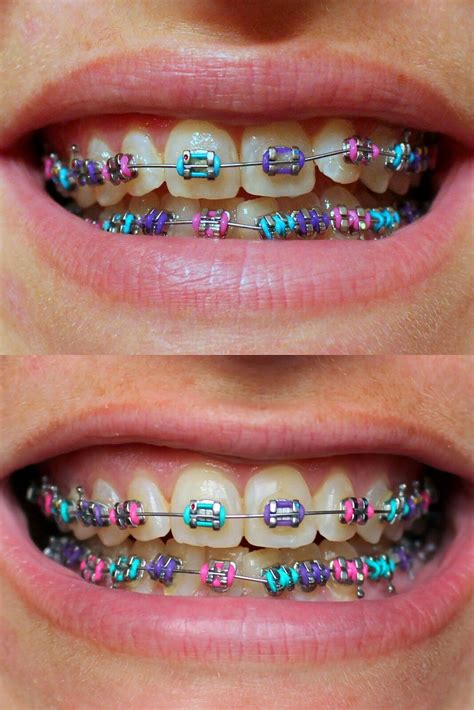 √ Braces Color Suggestions