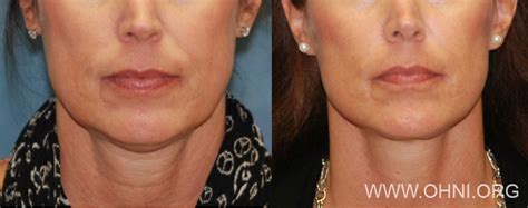 The Micro-Mini Lift®: Minimally Invasive Facelift