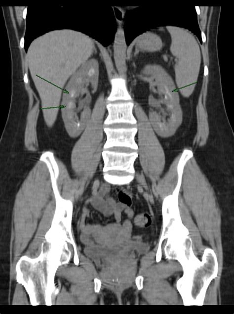 Nephrocalcinosis - wikidoc