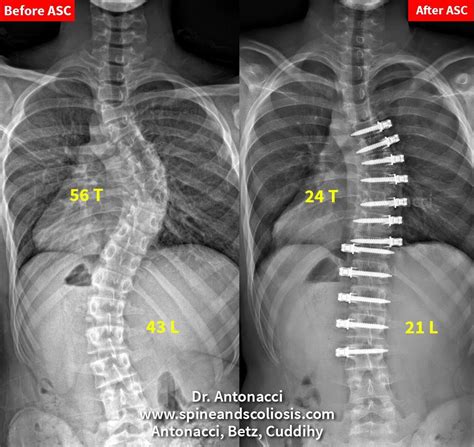 Scoliosis and Kyphosis – Institute for Spine and Scoliosis