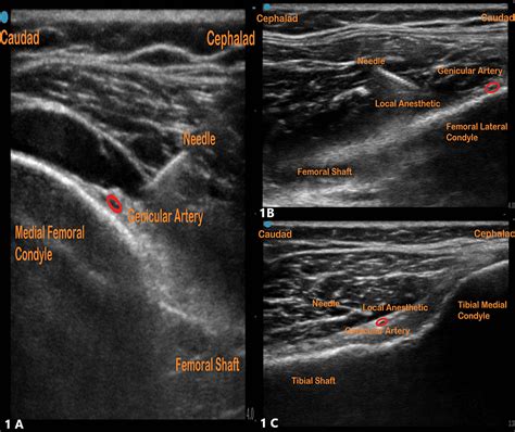 Ultrasound-Guided Genicular Nerve Blocks for Anterior Cruciate Ligament ...