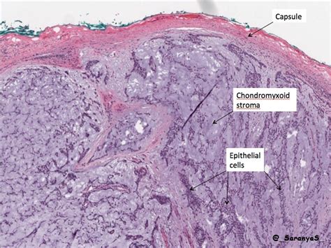 Pleomorphic Adenoma Pathology