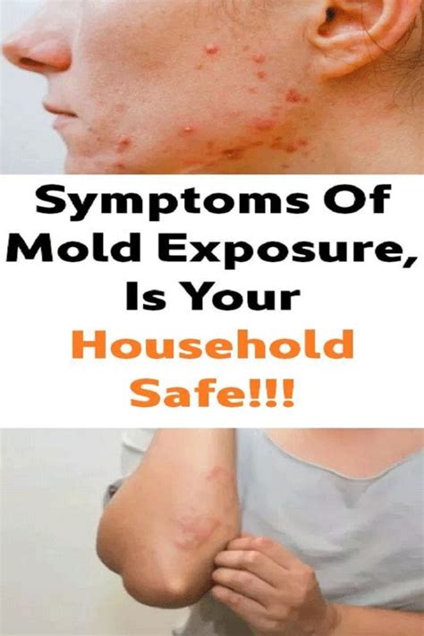 Symptoms Of Mold Exposure, Is Your Household Safe!!! | Mold exposure ...