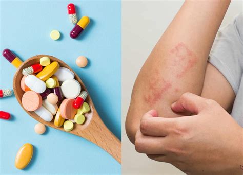 Alergi Obat: Jenis Obat, Gejala, Pencegahan dan Pengobatan