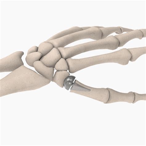 CMC Joint Replacement - The BioPro Modular Thumb Implant