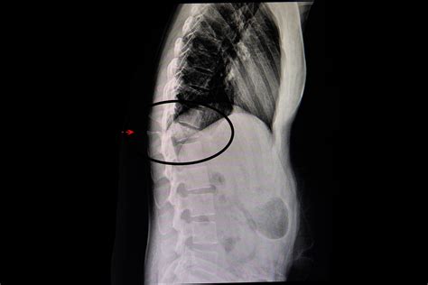 Compression and Wedge Fractures