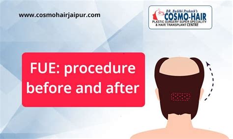 FUE: Procedure Before And After | Cosmo-Hair, Jaipur