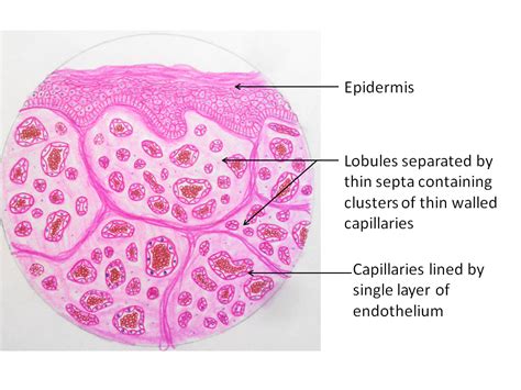 Capillary Hemangioma - Pathology Made Simple