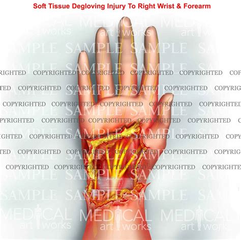 Right hand degloving injury – Medical Art Works