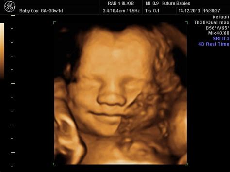 3d ultrasound week 28