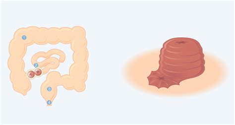 What is an Ileostomy? Types of Ileostomy | Salts Healthcare