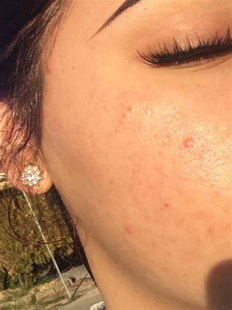 Teen Says Green Tea and Honey Cleared Cystic Acne – Before-and-After ...