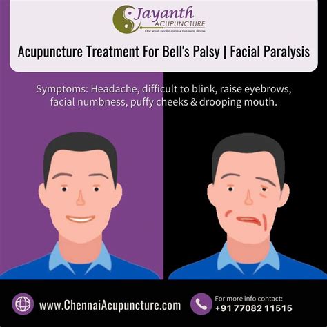 Facial Palsy Treatment at Rs 600/session in Chennai | ID: 6760453433