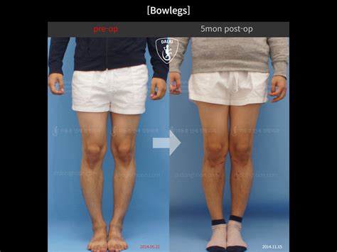 [Bowlegs] 5mon post-op : Adult Bowlegs