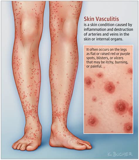 This Patient Page describes #vasculitis, focusing especially on skin ...