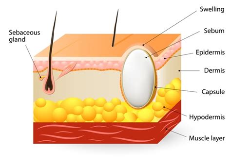 Skin Cysts (Sebaceous Cyst) - Awebfind.biz