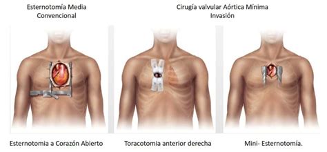 Open Heart Surgery - Mayo Clinic Care Network