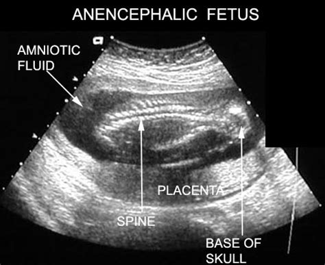 Anencephaly