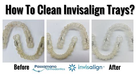 How To Clean Invisalign Retainers With Cleaning Crystals - AWIKZI