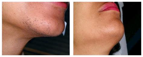 Before and After | Renova Laser Hair Removal & MedSpa Houston TX