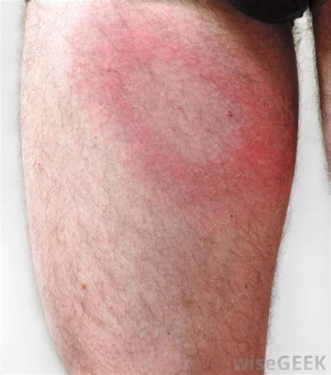 The characteristic bullseye rash for Lyme disease | Innatoss