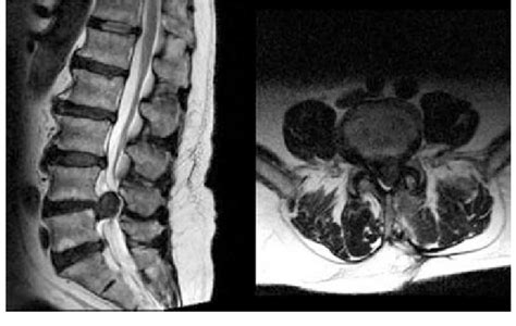 Lumbar Spine Mri Herniation