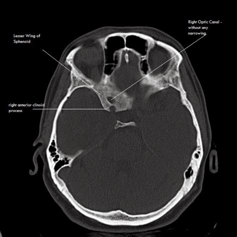 Ultimate Radiology : Case of the Day : Sclerotic Sphenoid lesion