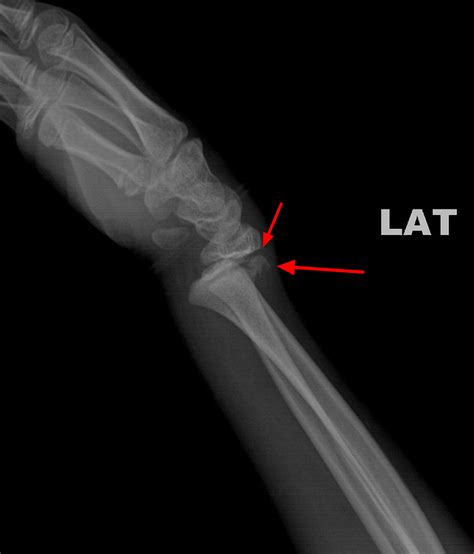 Different Types Of Wrist Fractures