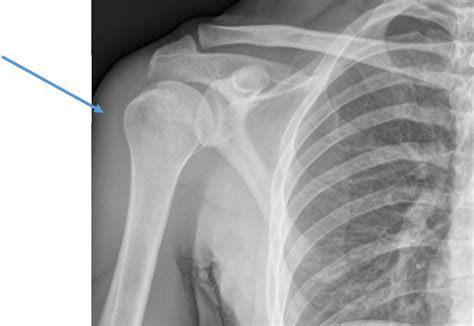 Proximal Humerus Fractures | Dr David Duckworth