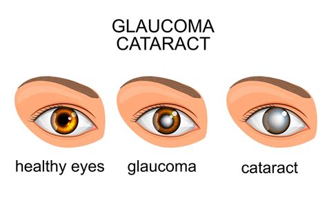 What's The Difference Between Glaucoma and Cataracts? - LASIK Monterey Park