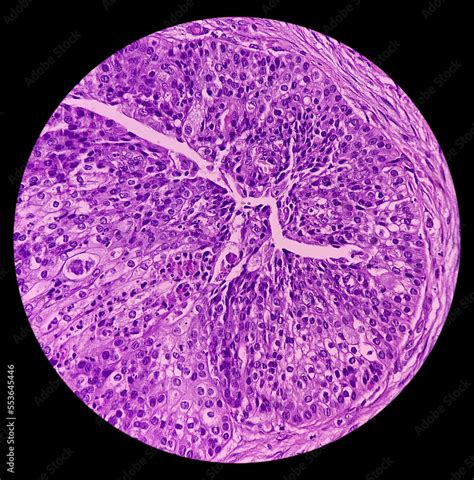 High grade mucoepidermoid carcinoma of parotid cyst. Microscopic show ...