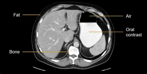 Abdominal CT: Attenuation • LITFL • Radiology library