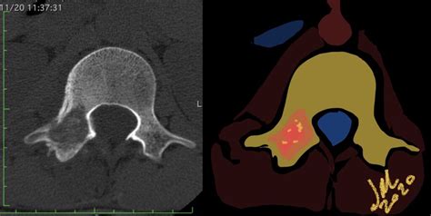 Aggressive Osteoblastoma | NeuroRad911