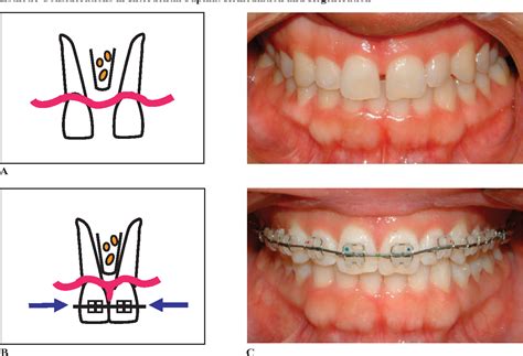 Figure 8 from Esthetic considerations in interdental papilla ...