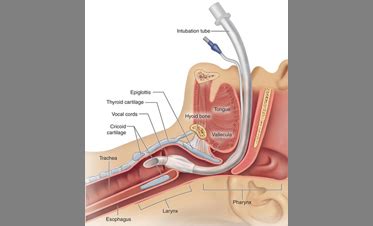 Intubation 101 - JEMS: EMS, Emergency Medical Services - Training ...