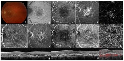 JCM | Free Full-Text | Subthreshold Exudative Choroidal ...