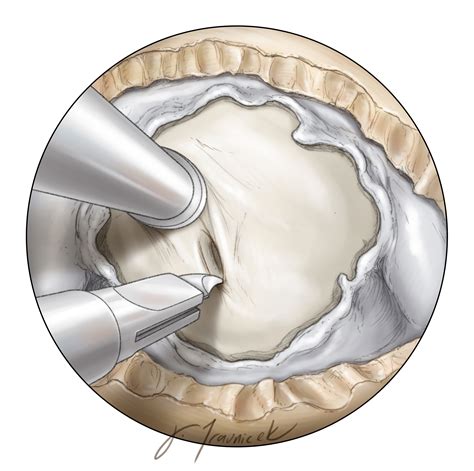 Craniopharyngioma | The Neurosurgical Atlas, by Aaron Cohen-Gadol, M.D.