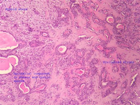 PLEOMORPHIC ADENOMA – Histopathology.guru