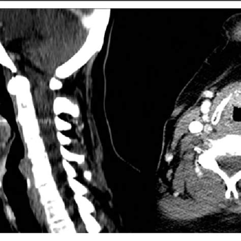 Different shapes of the epiglottis. a Type 1—omega-shaped epiglottis; b ...