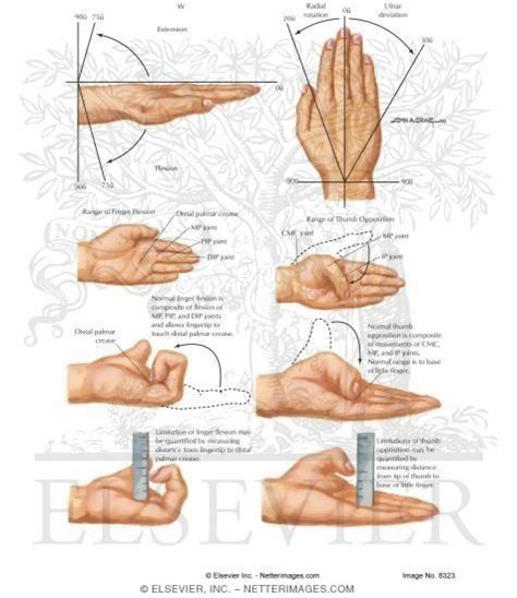 Measurement of Wrist Motion and Finger Motion, Lack of Finger Flexion ...