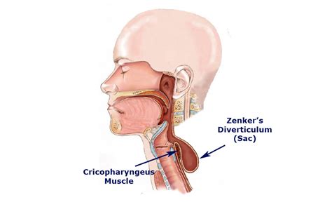 Zenker’s Diverticulum - ENT Clinic