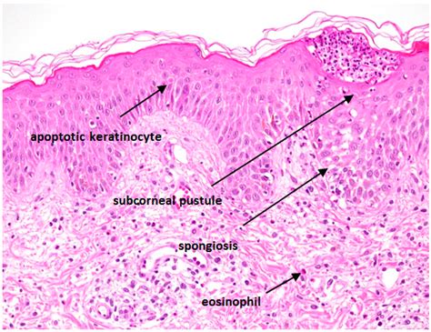 IJMS | Free Full-Text | Acute Generalized Exanthematous Pustulosis ...