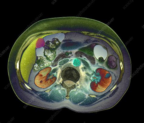 Pyelonephritis, axial CT scan - Stock Image - C047/4758 - Science Photo ...