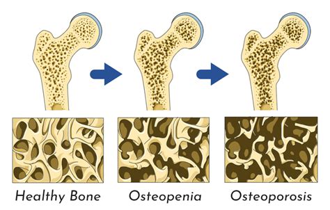 Osteopenia vs Osteoporosis | AllSpine