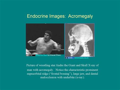 Acromegaly. Description - презентация онлайн