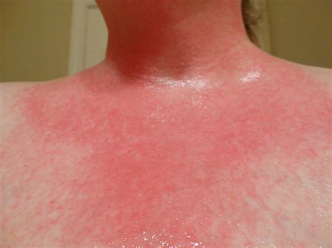 allergic reaction skin rash pictures - pictures, photos