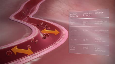 Hypertension shown and explained using medical animation still shot