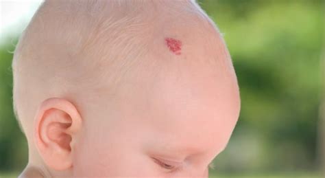 What causes birthmarks and can they be treated?