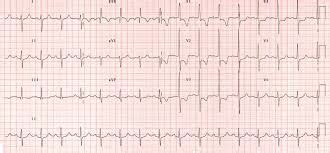 pe ecg changes - Google Search | Math, Nurse, Sheet music